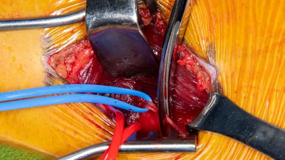 intraoperative view of nerve surgery