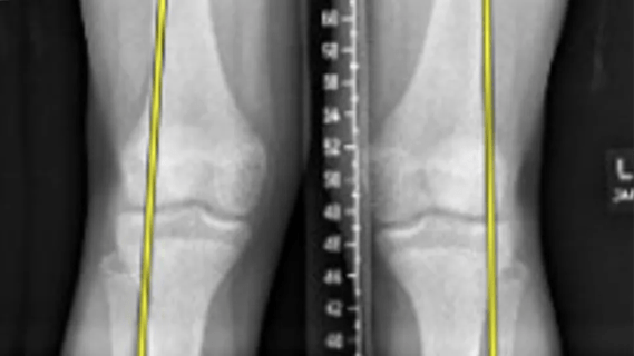 X-ray of patient with knock knees