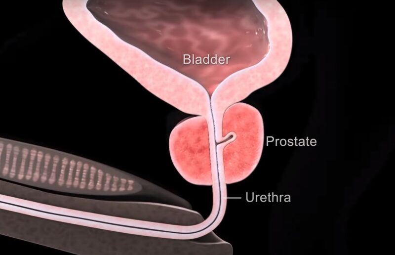 Benign Prostatic Hyperplasia