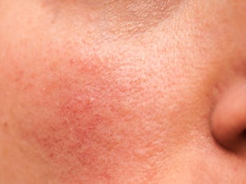 Rosacea face