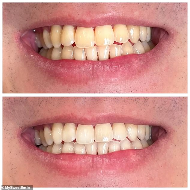 The transformation photos prove it works, and customers who have tried the MySweetSmile Teeth Whitening Powder attest to its whitening abilities sharing how its 'worked wonders'