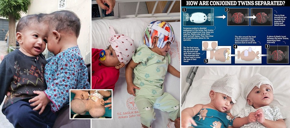 British surgeons successfully separate conjoined twins in radical 14-hour operation