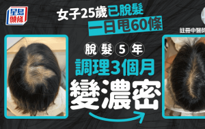 產後脫髮｜脫髮5年！港女25歲起日掉60條頭髮 中醫調理3個月變濃密