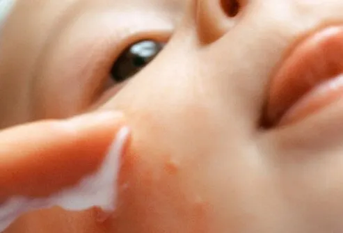 Photo of baby with pimples rash.