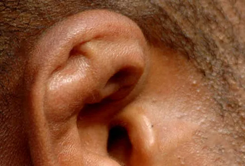 Common among wrestlers, this is caused by repeated hits and cuts to the ear.