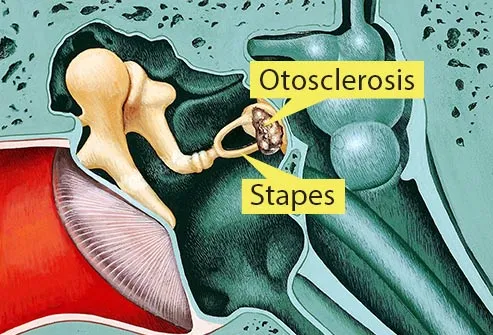 Sometimes one of the bones in your middle ear, called the stapes, gets stuck in place and can't vibrate.