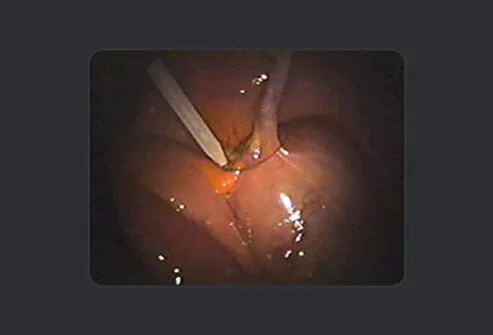 The surgeon crushes the base of the appendix with a clamp.