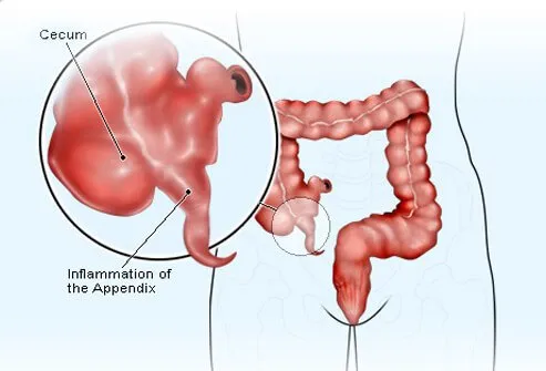 Appendicitis can occur when mucus, stool, a growth, or a combination of these blocks the opening of your appendix that leads to the cecum.