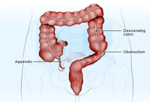 In these cases, a nasogastric tube may be necessary to drain the contents that cannot pass.