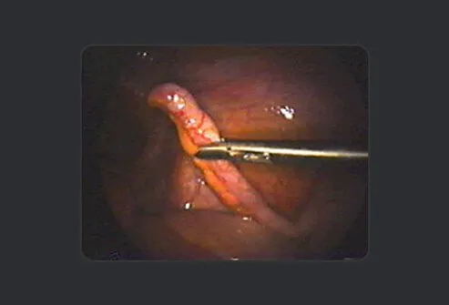 The surgeon removes it to prevent potential appendicitis in the future.