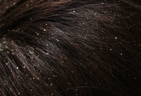 ACV is not a proven home remedy for dandruff. 