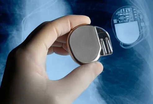 Pacemakers for AFib treatment are implanted if a patient suffers from a heart rate that is too slow.