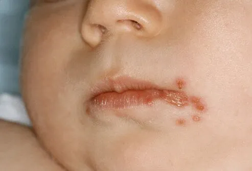 Eczema is the most common cause of itchy rashes in babies.