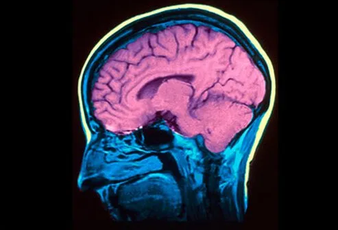 While no single cause of bipolar disorder has been identified, there are a number of factors that contribute to the development of this illness.