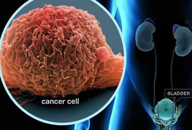 Bladder cancer is the unregulated growth of abnormal bladder or cancerous cells on the inner lining of the bladder wall.