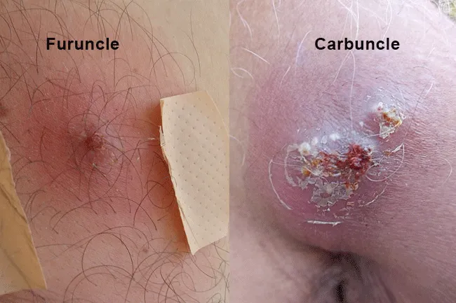 Carbuncles are considered more serious skin conditions.