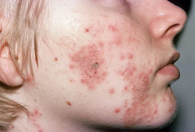 Cystic acne affects deeper skin tissue than common acne.