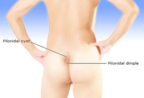 A pilonidal cyst is a unique kind of abscess that occurs in or above the crease of the buttocks.