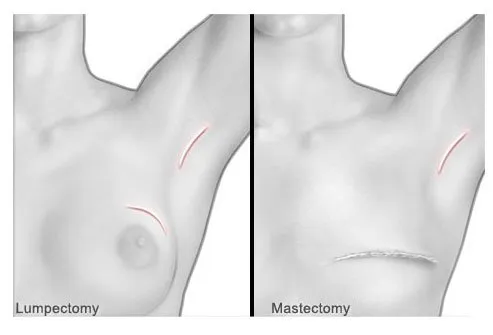 Breast cancer surgery for the removal of tumors.