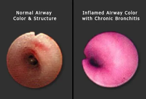 Chronic bronchitis is a recurrent disorder where there is chronic inflammation, swelling, and narrowing of the airways.