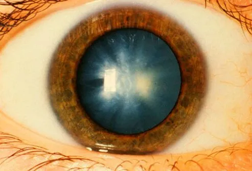 It is not precisely understood why people get cataracts.