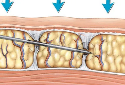 This is a surgical technique whereby the bands of dermal fibrous tissue are severed by a needle.