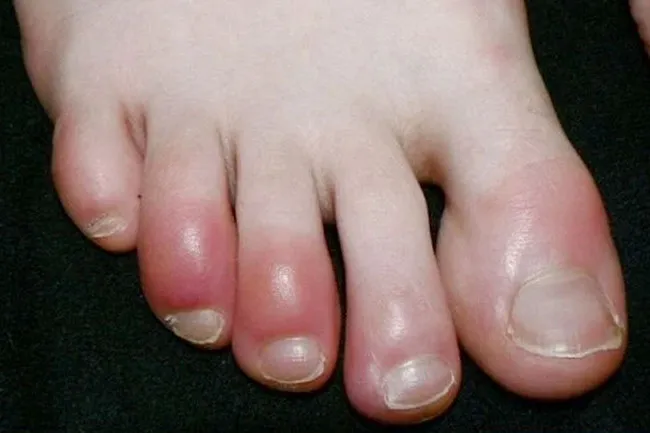 Skin rash symptoms such as Covid toe have become associated with Covid-19 