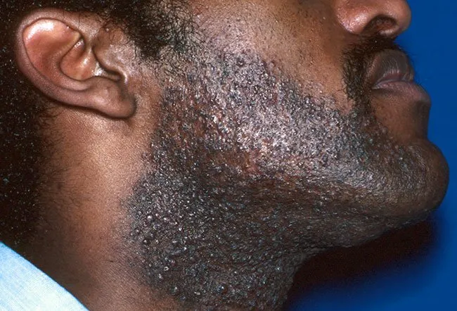 This eruption occurs in areas of the skin in which hairs have been recently cut or extracted.