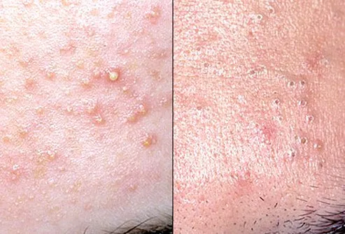 Acne occurs in all teenagers as they progress through puberty.