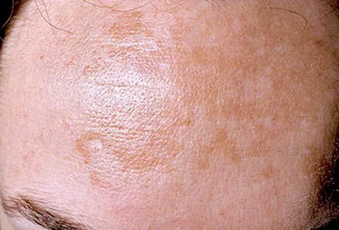 The main symptoms are brown patches of skin. These patches are typically found on your face.