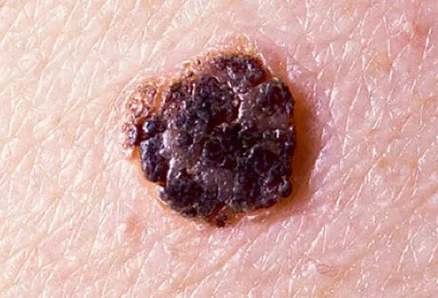 Lesions may be present anywhere on the body and generally do not produce symptoms.