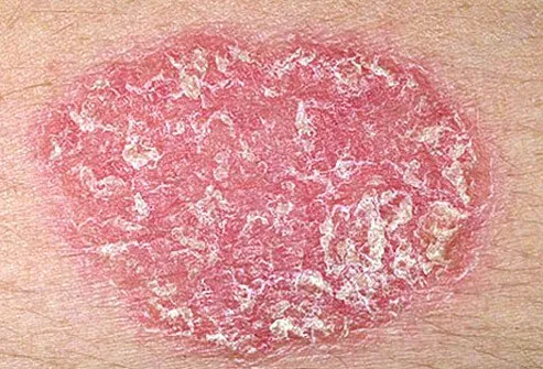 Psoriasis is a rash of thick plaques covered with silvery scales.