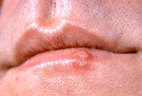 Cold sores commonly appear on the edge of the lip.