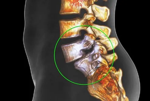 Spondylolisthesis is a main cause of lower back pain.