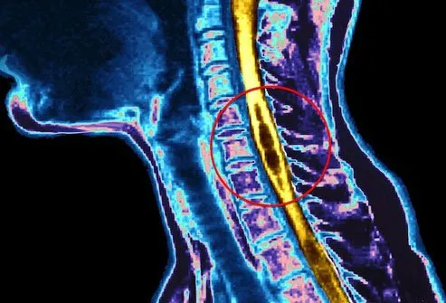 In rare cases, a little fluid-filled sac called a cyst can form in your spinal cord.