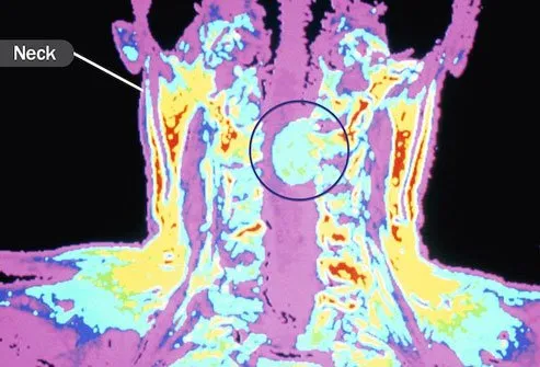 Sometimes, cancer spreads from the spot where it starts to form a new growth in your spine.