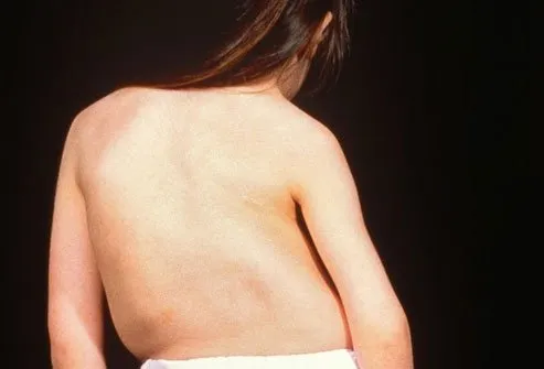 Scoliosis is one of the conditions that can twist your spine out of shape.