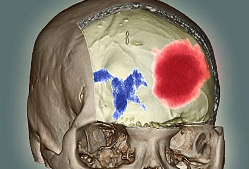 Bleeding inside the brain is a medical emergency. The blood, under pressure, has no place to drain so it often pools and forms a hematoma.