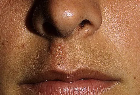 Cold sores don't always appear on the lips.