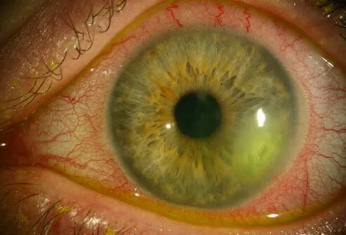 HSV can infect the eye (ocular herpes) or the finger (herpetic whitlow).