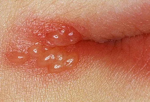 Cold sores, despite the name, are not caused by the common cold viruses.