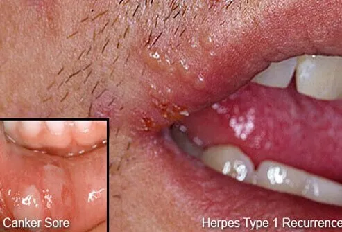 Photo of herpes blisters on the lip with an inset of a canker sore on the inner lip