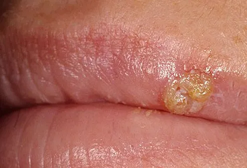 HSV is contagious from the time the skin turns itchy or red until the sores heal.