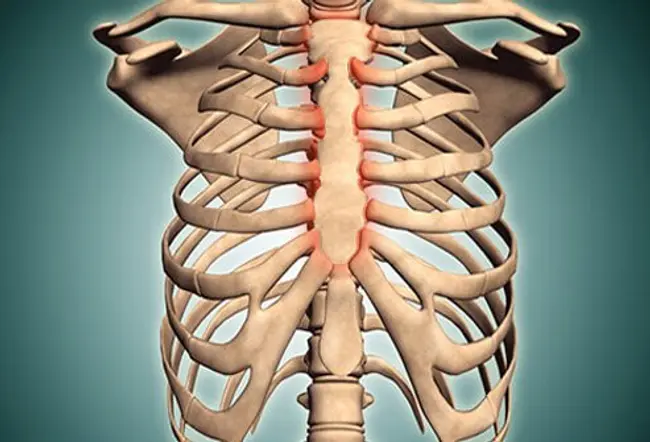 Costochondritis is an inflammation of the area where the ribs join the cartilage that is attached to the sternum (breast bone).