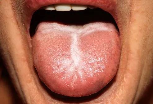 An overgrowth of candida in your mouth is called thrush. 