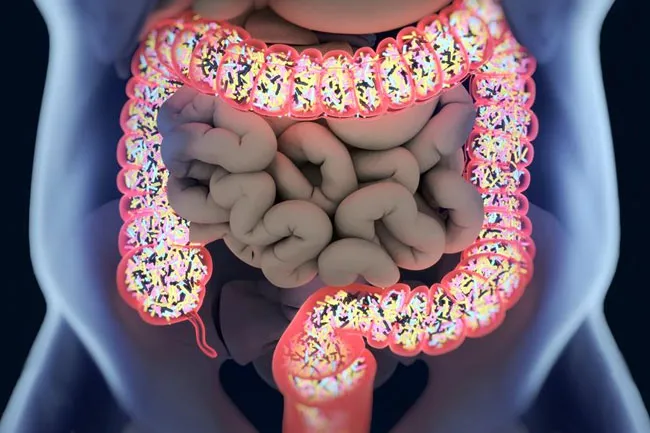 People with Crohn’s and other forms of irritable bowel disease (IBD) lack some of the gut microbes found in other people.