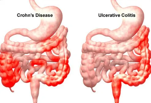 Both Crohn's disease and ulcerative colitis are chronic diseases of intestinal inflammation.