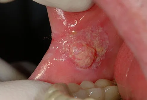 Early oral cancer (squamous cell carcinoma) in the mouth of a heavy smoker.