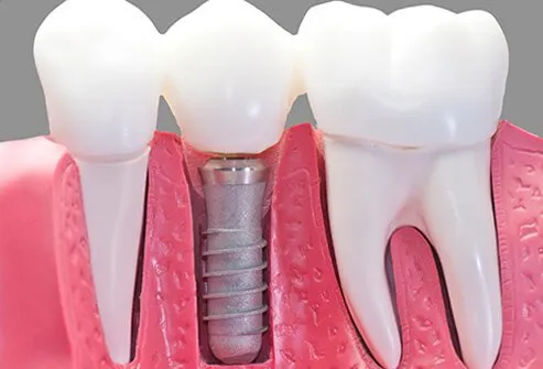 Model of dental implant.