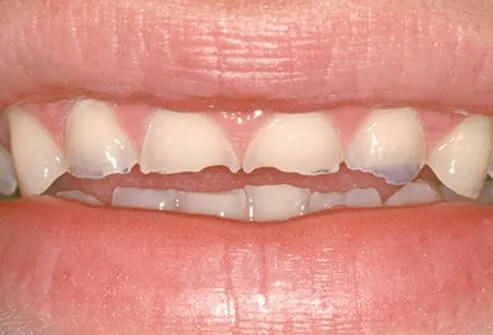 Tooth enamel erosion damaged by bulimia.